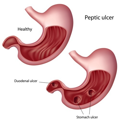 Peptic ulcers often develop due to bacteria infection