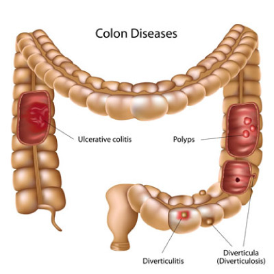 Diverticulosis Diverticulitis, Why Are My Stools Narrow
