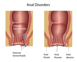 Hemorrhoids, or piles, are one of mankind’s most common and nagging disorders. By themselves, hemorrhoids are rarely serious, but they can be extremely troublesome. In some instances, they may mask a more serious disorder, such as colon or rectal cancer. Therefore, hemorrhoids require the proper diagnosis and treatment by a physician. Hemorrhoids are dilated (enlarged) […]