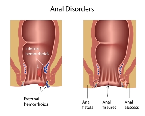 What should you do for hemorrhoids?