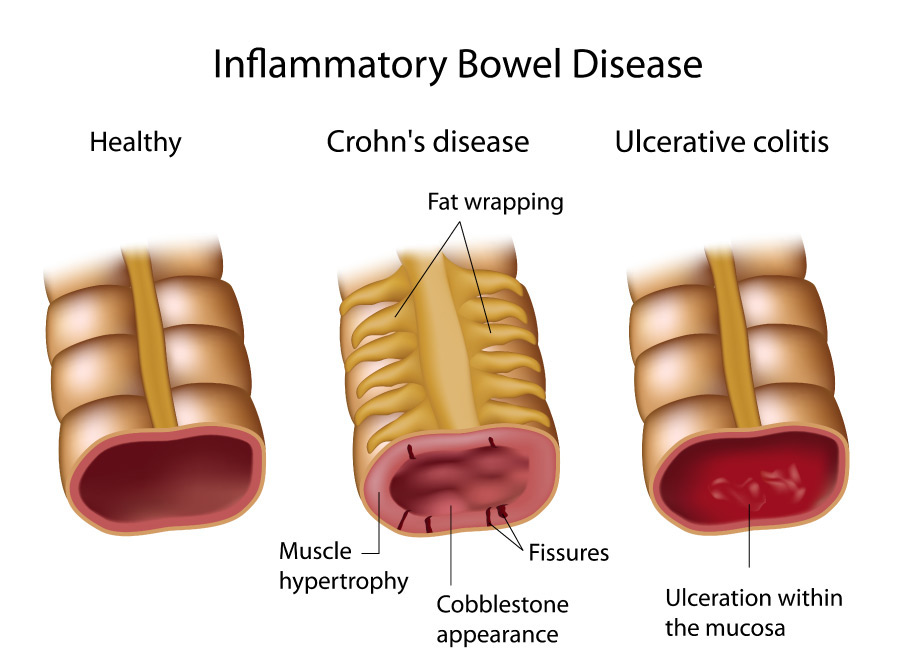 Gicare Diets Gastroparesis Diet