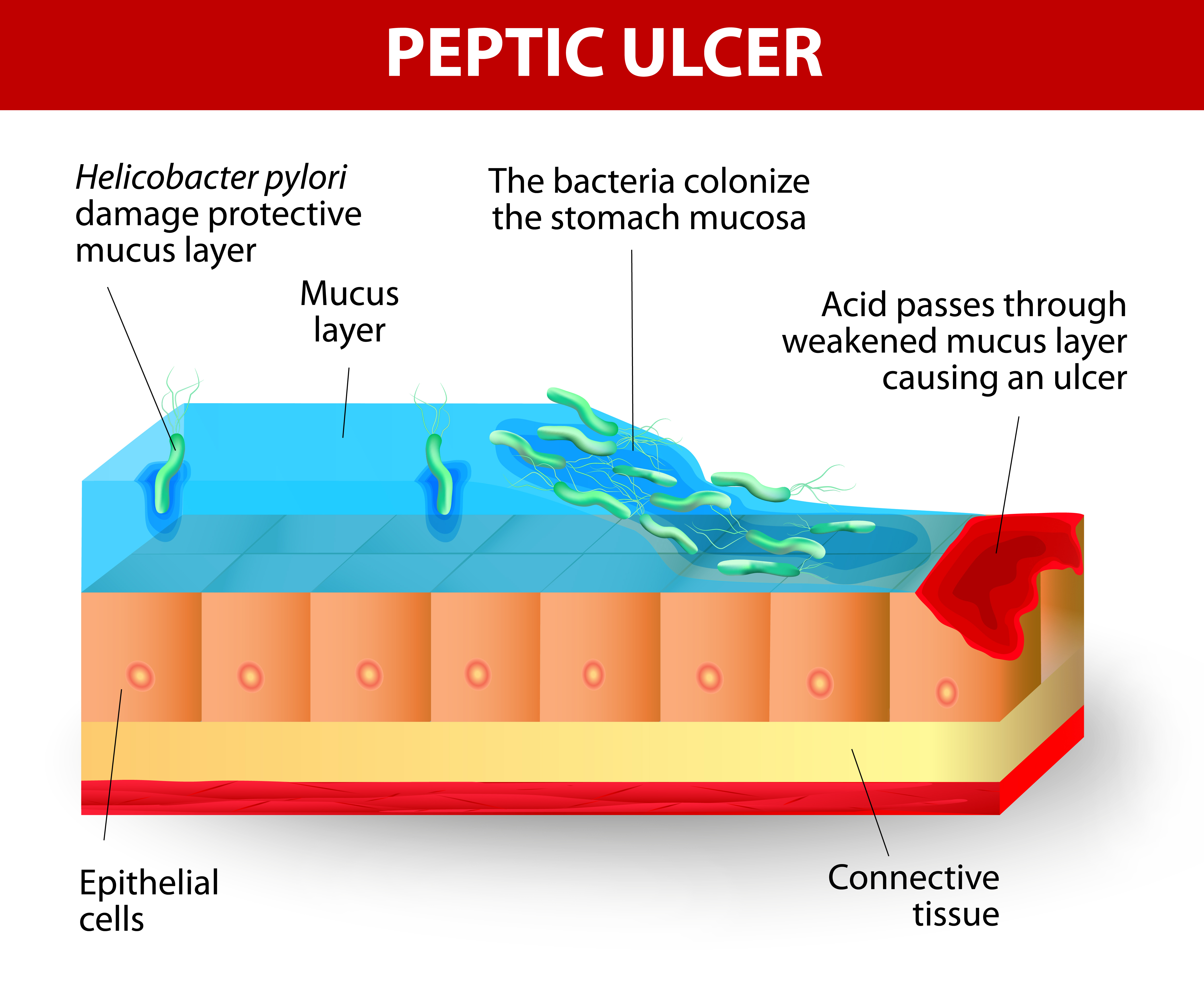 Can Pepto-Bismol be used to control a bleeding ulcer?