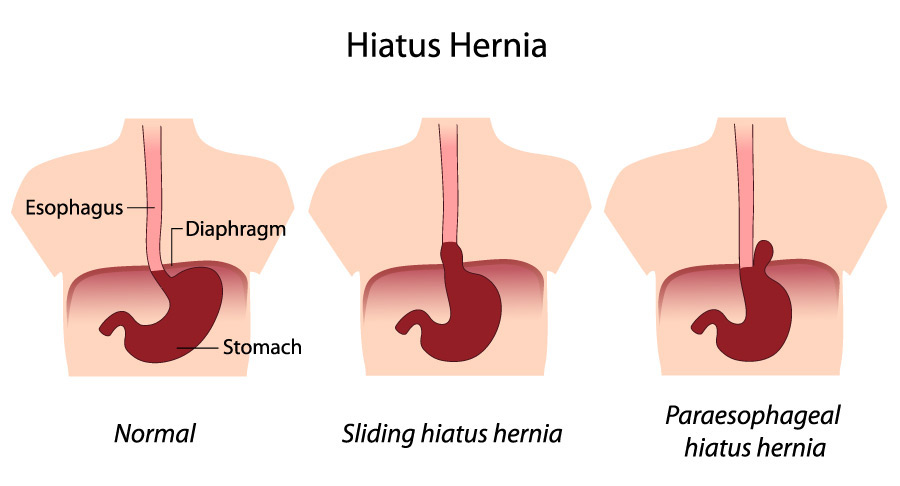 Acid reflux symptoms persistent cough