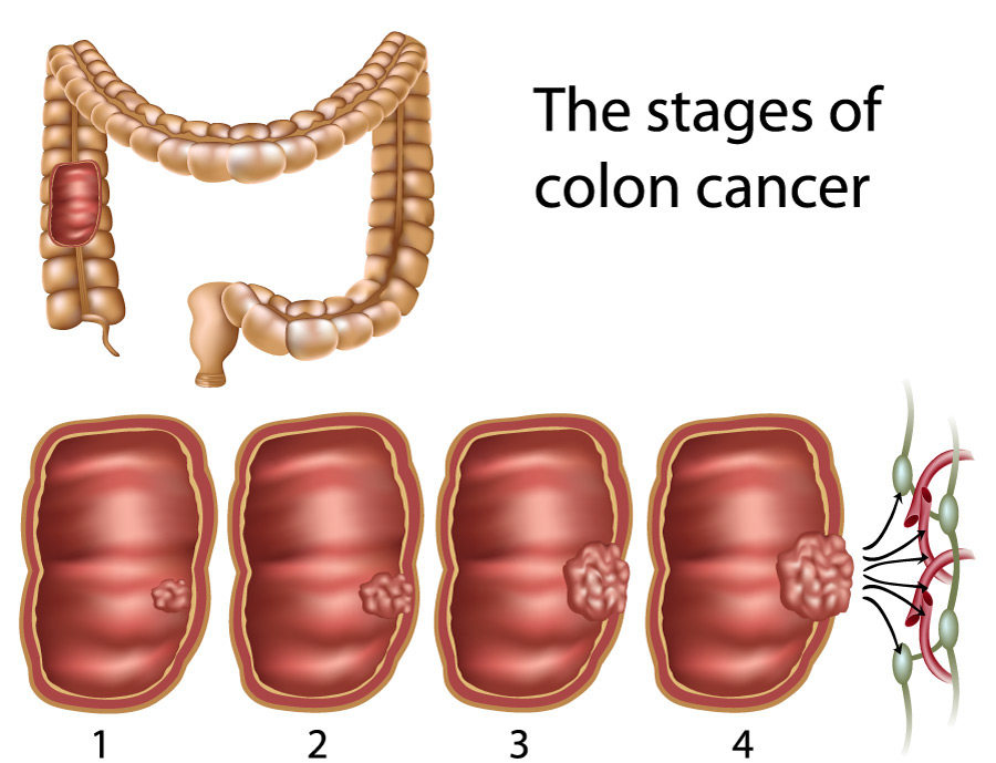cancer benign de colon)