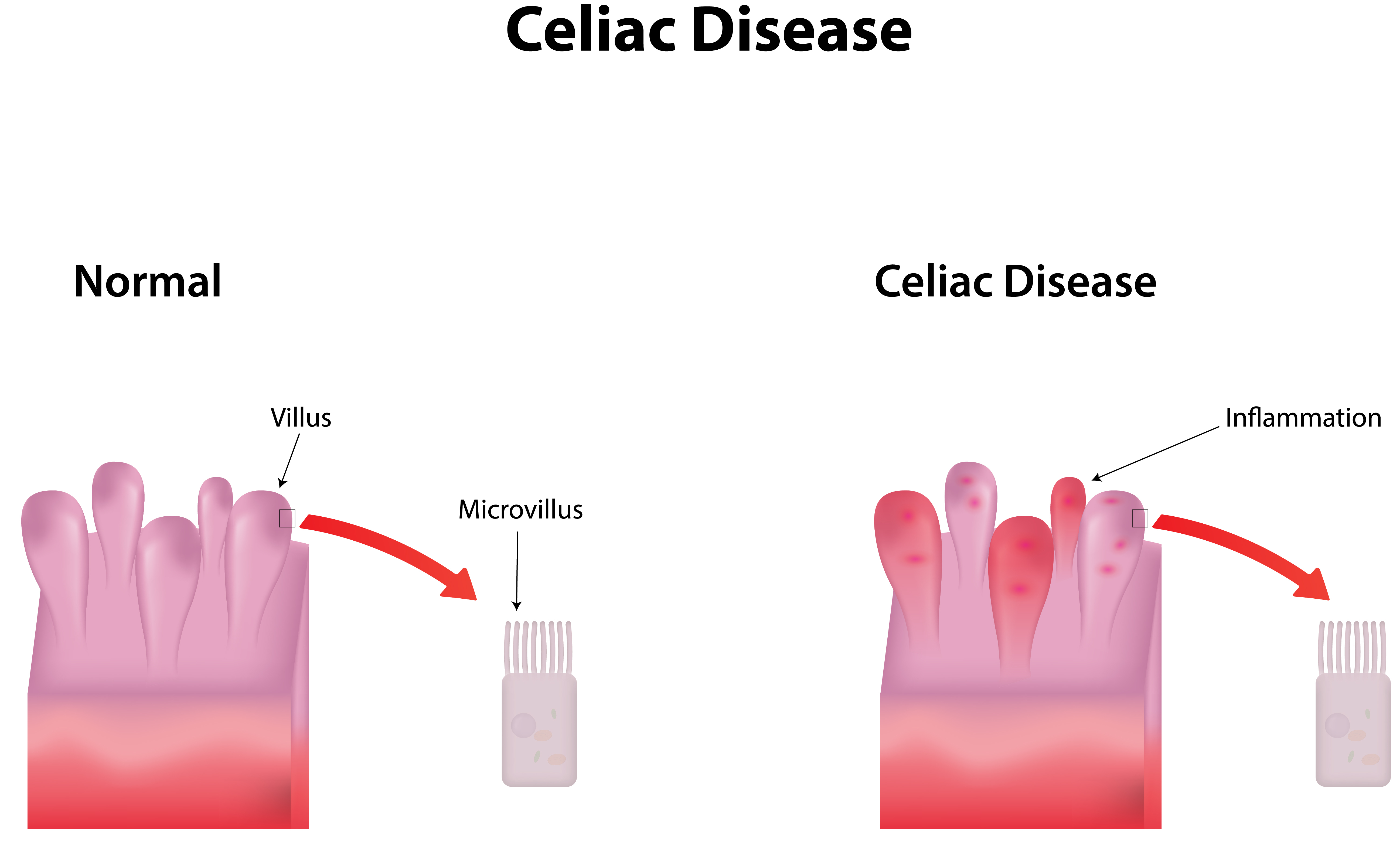 Celiac Chart