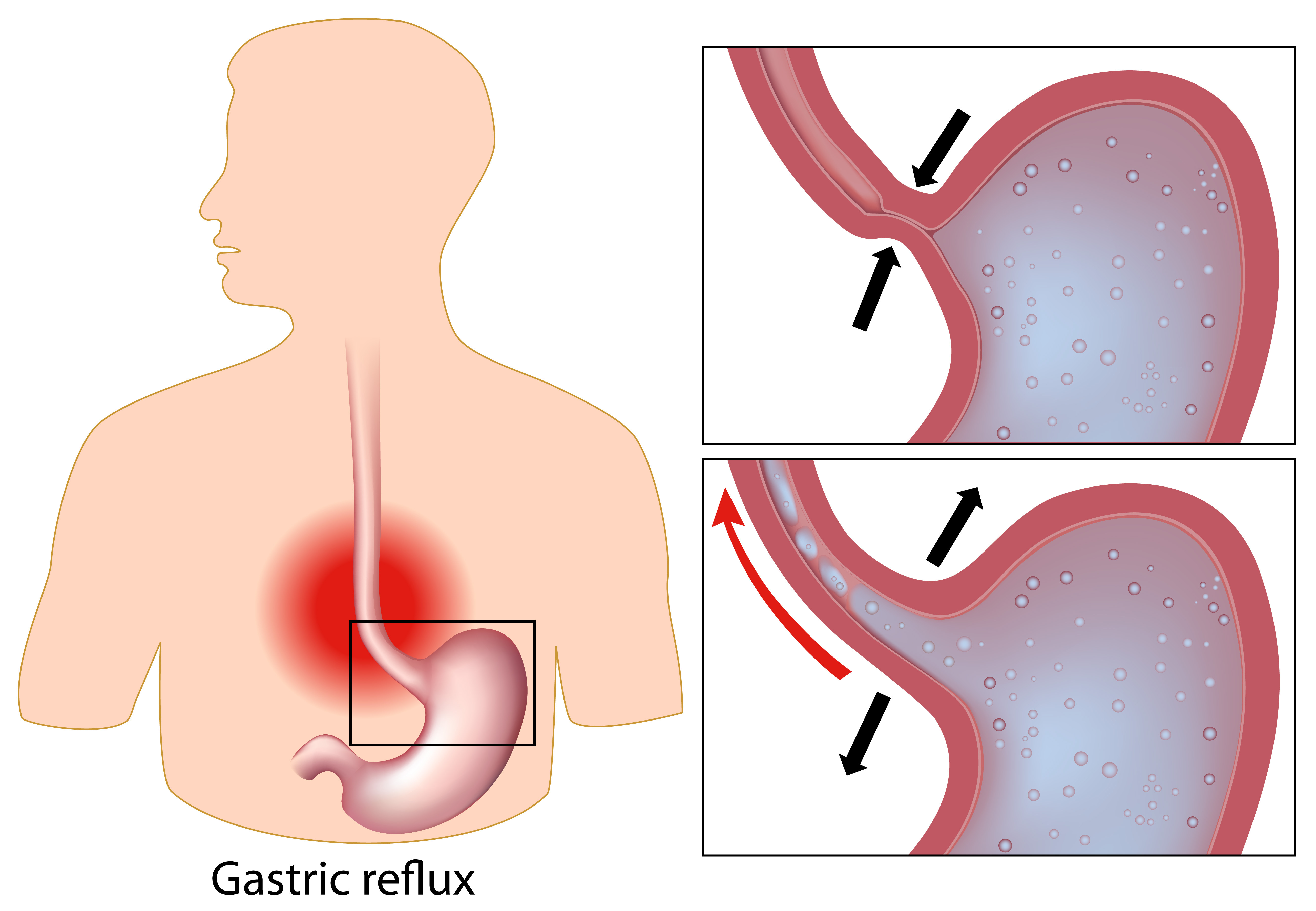 Can narrowing of the esophagus cause excess mucus in the throat and coughing?