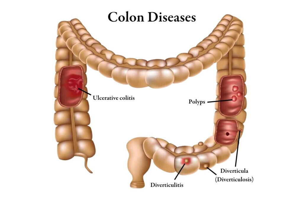 image of colon with visual of four diseases